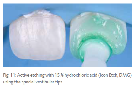 Fig. 11: Active etching with 15 % hydrochloric acid (Icon Etch, DMG) using the special vestibular tips.